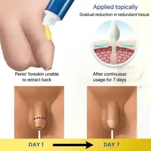 BaoBee™ Redundant Prepuce Corrector Gel - Image 4