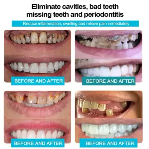 Bearnica ™ Silicone Reline Denture Set - Image 5