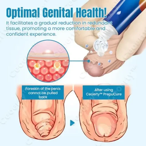 Ceoerty™ PrepuCure Foreskin Corrector Gel - Image 4