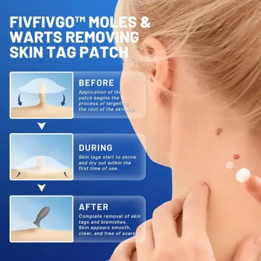 Fivfivgo™ Moles & Warts Removing Skin Tag Patch - Image 3