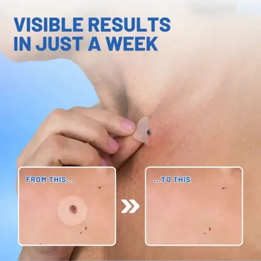 Fivfivgo™ Moles & Warts Removing Skin Tag Patch - Image 6