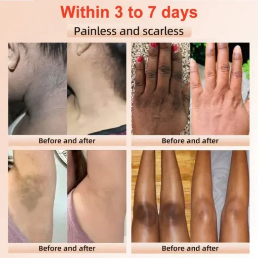 Fivfivgo™ Purifying Exfoliating Gel for Acanthosis Nigricans, Exfoliation - Image 2