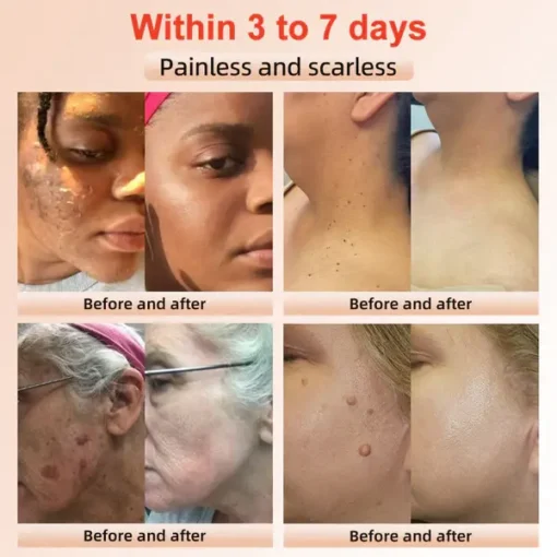 Fivfivgo™ Purifying Exfoliating Gel for Acanthosis Nigricans, Exfoliation - Image 3