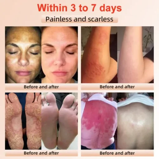 Fivfivgo™ Purifying Exfoliating Gel for Acanthosis Nigricans, Exfoliation - Image 5