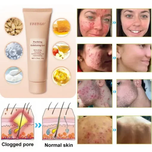 Fivfivgo™ Purifying Exfoliating Gel for Acanthosis Nigricans, Exfoliation - Image 9