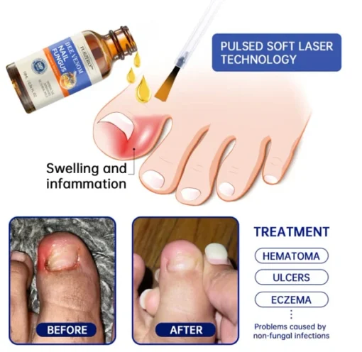 Furzero™ Bee Venom Nail Fungus Treatment Solution: Restore nail health - Image 13