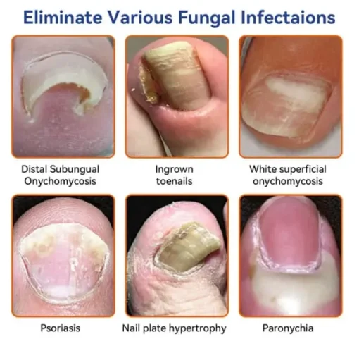 Furzero™ Bee Venom Nail Fungus Treatment Solution: Restore nail health - Image 8