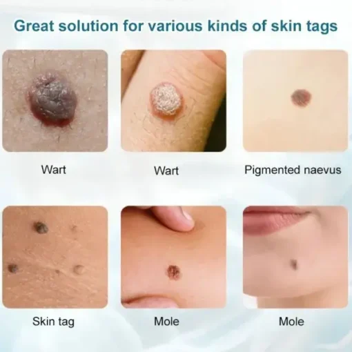 HZA™ Concentrated powerful skin tag removal cream - Image 6