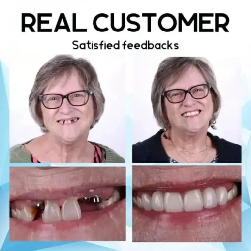 Oveallgo™ Silicone Reline Denture Set - Image 6