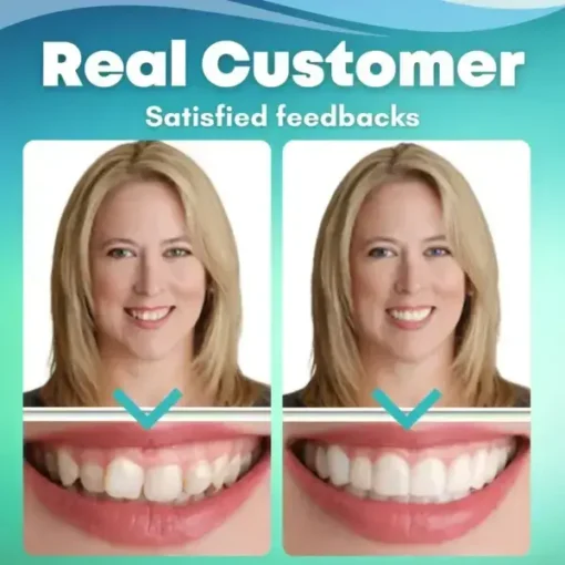 Winter Sale EzySmile™ SnapOn Silicone Veneers - Image 5