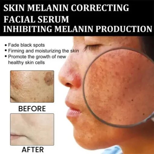 Winter Sale Fast Dark Spot Remover-NESLEMY™ Melanin Correcting Facial Serum - Image 3