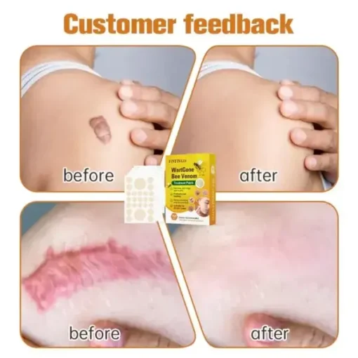 Fivfivgo™ WartGone Bee Venom Treatment Patch - Image 3