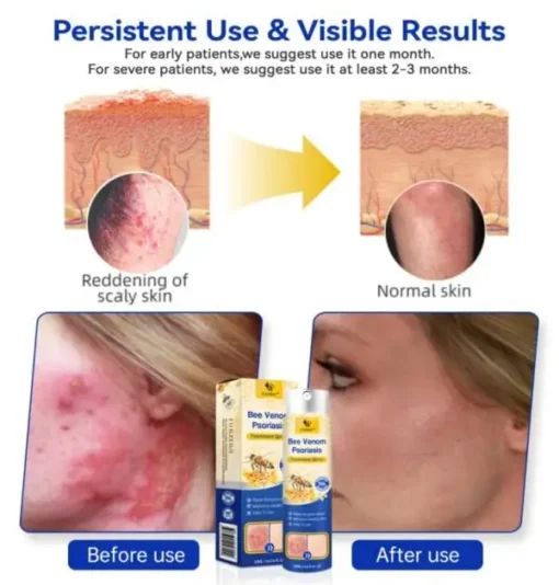 Winter Sale CroAie™ PsoriaHeal Bee Venom Psoriasis Treatment Spray plus - Image 5