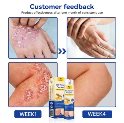 Winter Sale CroAie™ PsoriaHeal Bee Venom Psoriasis Treatment Spray plus - Image 6