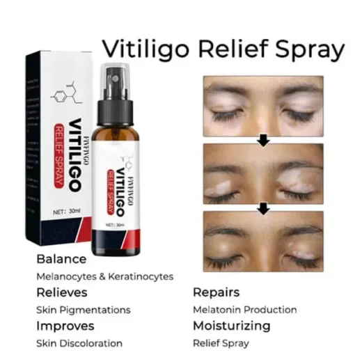 Fivfivgo™ Vitiligo Relief Spray - Image 3