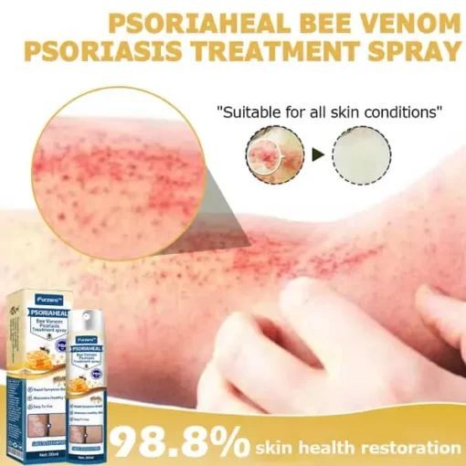 Furzero™ PsoriaHeal Bee Venom Psoriasis Treatment Spray Plus - Image 10