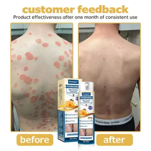 Furzero™ PsoriaHeal Bee Venom Psoriasis Treatment Spray Plus - Image 4