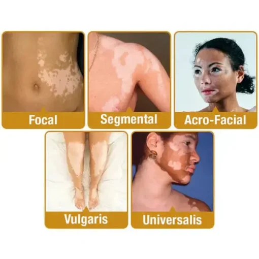 Winter Sale Vitiligo Bee Venom Treatment Cream - Image 4